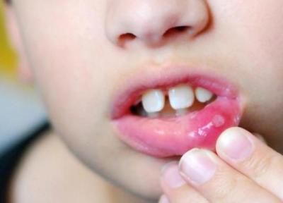 راهکارهایی برای درمان آفت دهان کودک